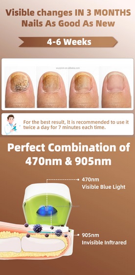 Nail Laser Device 16